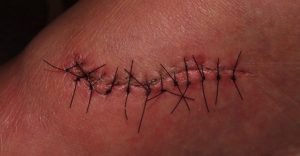 Khâu vết thương thẩm mỹ có để lại sẹo không