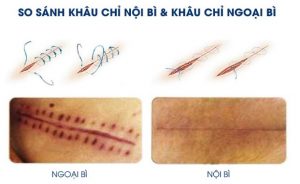 Các phương pháp khâu vết thương thẩm mỹ nhanh lành