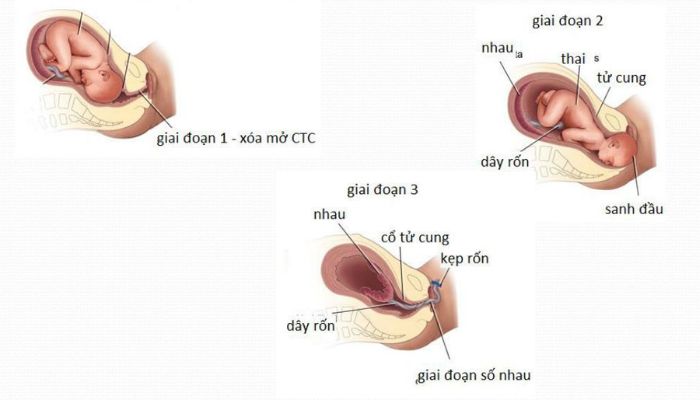 Chuyển dạ là gì? Các giai đoạn của chuyển dạ