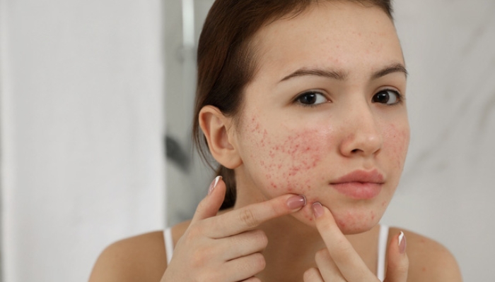 Tại sao cần skincare cho da dầu mụn ban đêm?