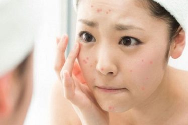 chăm sóc da sau nặn mụn