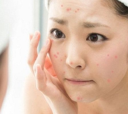 chăm sóc da sau nặn mụn