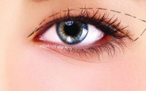 Cắt mí mắt sử dụng chỉ khâu gì?