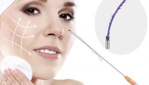 Nâng mũi bằng chỉ là gì?