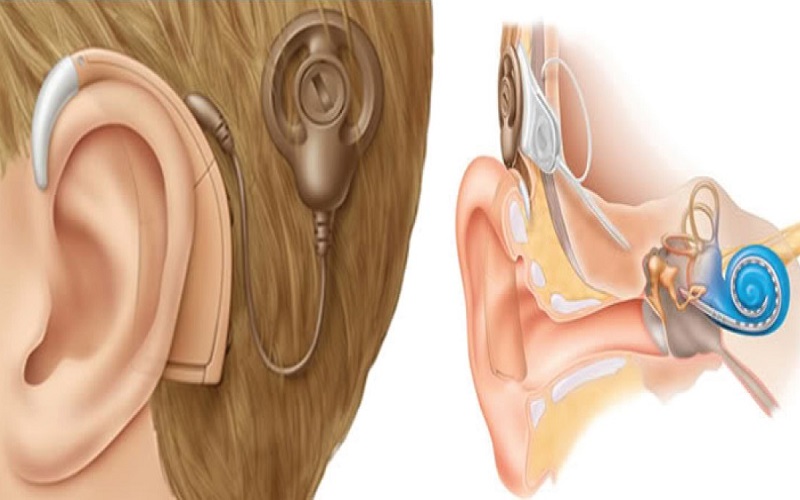 phẫu thuật cấy cực điện ốc tai